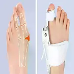 Ayarlanabilir Ayak Baş Parmak Kek Düzeltici – Halluks Valgus (Bunyon) Aparatı, Gece Gündüz Kullanıma-3